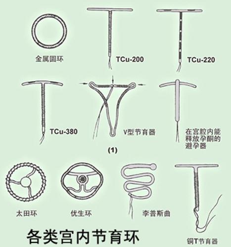 最新節(jié)育環(huán)研究進(jìn)展與應(yīng)用概述